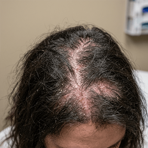Before Treatment